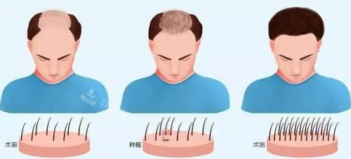 种植毛囊过程图