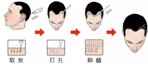 植发详细过程示意图