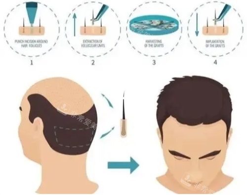 植發(fā)毛囊生長過程圖