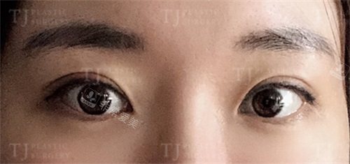 韩国TJ整形外科眼修复术后15天