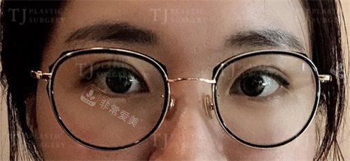 眼修復(fù)術(shù)后15天 眼修復(fù)術(shù)后15天
