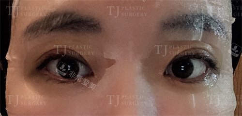 韩国TJ整形眼修复术后15天