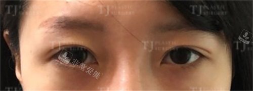 韓國(guó)TJ整形眼修復(fù)術(shù)前