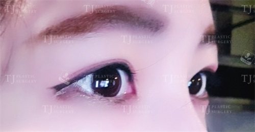 韩国TJ整形眼修复术后侧面图