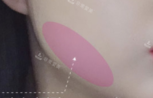 瘦臉注射位置示意圖 瘦臉注射位置示意圖
