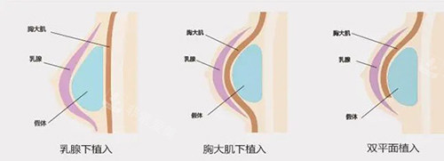 隆胸假體植入時的不同位置 隆胸假體植入時的不同位置