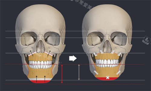 韩国EU颌面轮廓整形外科双鄂手术动画图