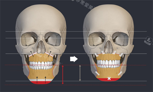 韓國EU頜面輪廓整形外科雙鄂手術動畫圖