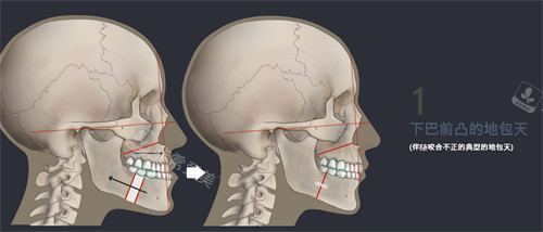 下巴前凸地包天改善图示