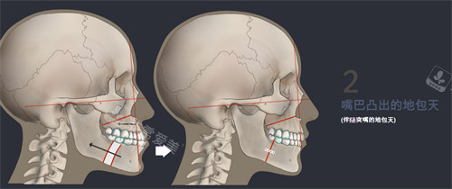 嘴巴凸出包天改善图示