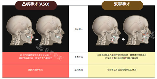 凸嘴手術(shù)和雙鄂手術(shù)對(duì)比展示