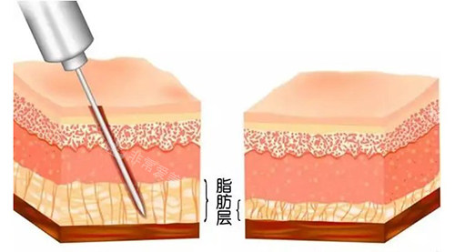 吸脂脂肪層示意圖 吸脂脂肪層示意圖
