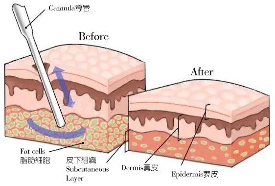 吸脂前后對比