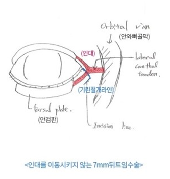 韩国绮林整形医院7MM开眼角手术示意图