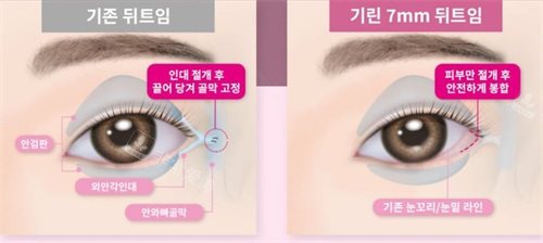 传统开眼角手术对比韩国绮林整形医院7mm开眼角