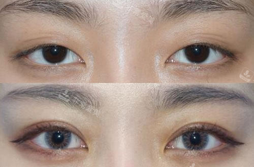 韩国秀美颜整形外科网红风格双眼皮塑造