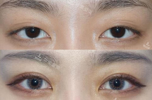 韓國秀美顏整形外科網(wǎng)紅風格雙眼皮塑造 韓國秀美顏整形外科網(wǎng)紅風格雙眼皮塑造