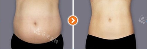韩国365mc医院腰腹吸脂手术示意图