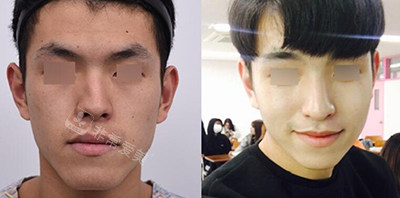 韩国GNG整形外科官网男生鼻部整形图