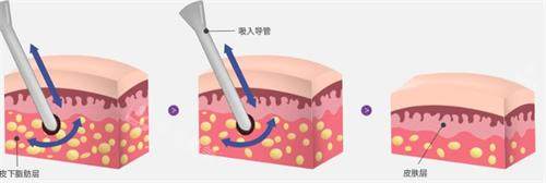 韩国芙莱思吸脂手术示意图