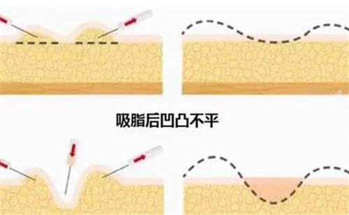 韓國芙萊思整形醫(yī)院脂肪圖 韓國芙萊思整形醫(yī)院脂肪圖