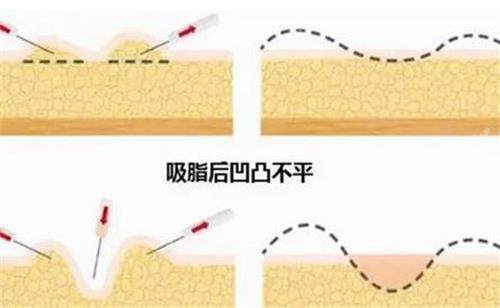 韩国芙莱思整形医院脂肪图