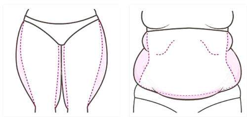 韩国芙莱思整形医院大腿腹部吸脂示意图