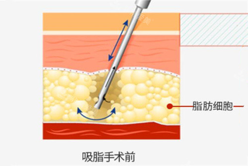 吸脂手术前皮下各部位含脂肪细胞示意图 吸脂手术前皮下各部位含脂肪细胞示意图
