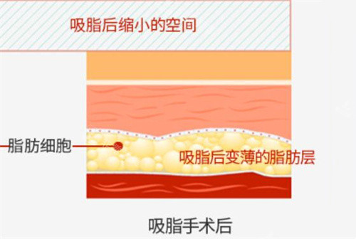 吸脂手术后脂肪层变化示意图 吸脂手术后脂肪层变化示意图