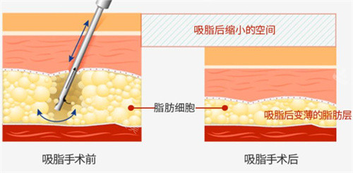 吸脂手术前后脂肪层示意图