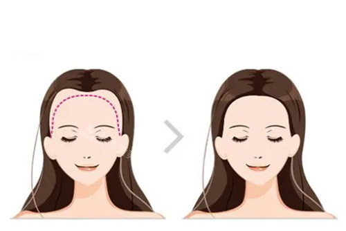 女性發(fā)際線植發(fā) 女性發(fā)際線植發(fā)