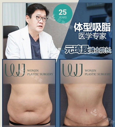 元琦晸院長腰腹吸脂手術(shù)對比 元琦晸院長腰腹吸脂手術(shù)對比
