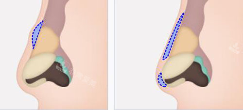 韩国秀美颜做肋软骨隆鼻靠谱吗，有没有隆鼻对比图？