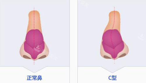 韩国秀美颜做肋软骨隆鼻靠谱吗，有没有隆鼻对比图？