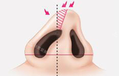 韩国秀美颜做肋软骨隆鼻靠谱吗，有没有隆鼻对比图？