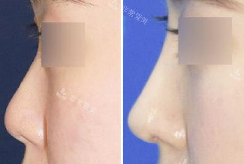 韩国秀美颜整形外科隆鼻前后对比图