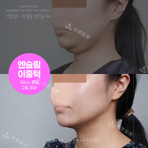 韩国N-slim吸脂医院面部吸脂对比照