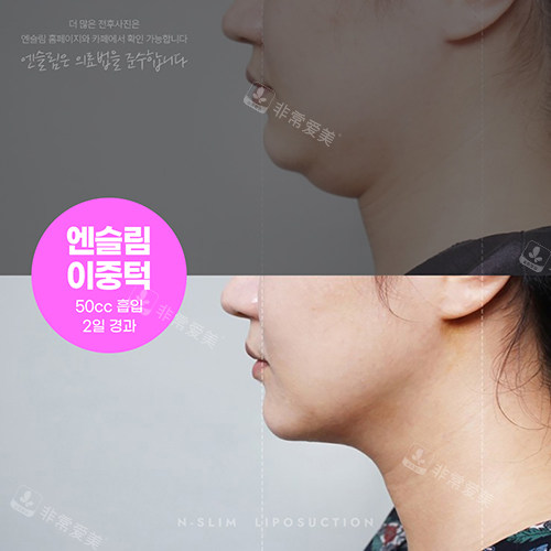 韩国N-slim吸脂医院面部吸脂前后对比