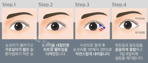 韩国绮林整形医院7mm开眼角手术过程示意图