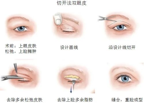 切开法双眼皮手术过程