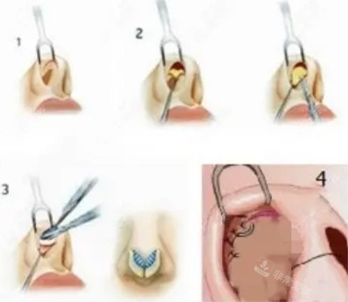 鼻整形手術(shù)過程圖