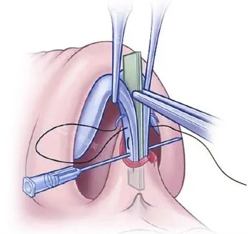 隆鼻手术缝合示意图