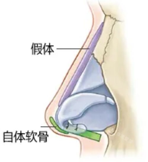 假体自体软骨隆鼻示意图