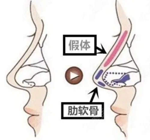 假体肋软骨隆鼻示意图