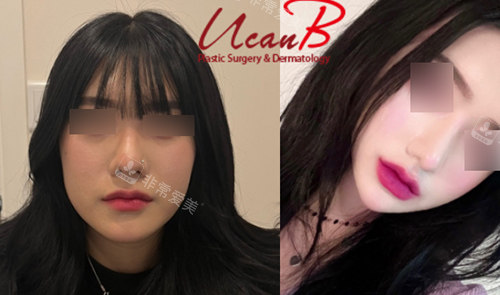 韩国UcanB整形外科鼻头鼻翼整形