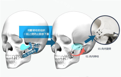 颧骨手术操作过程示意图