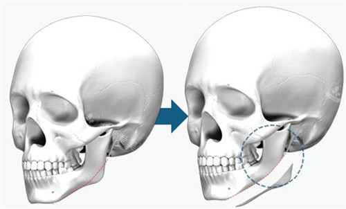 普通下颌角截骨和长曲线下颌角截骨示意图