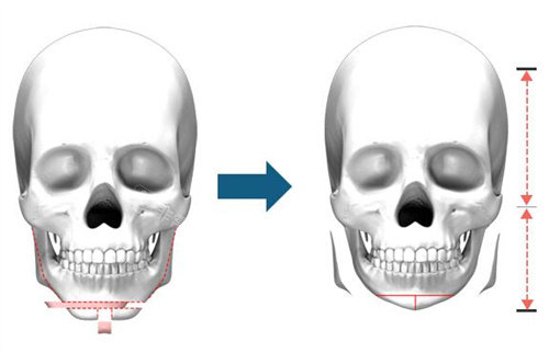 下巴整形示意图