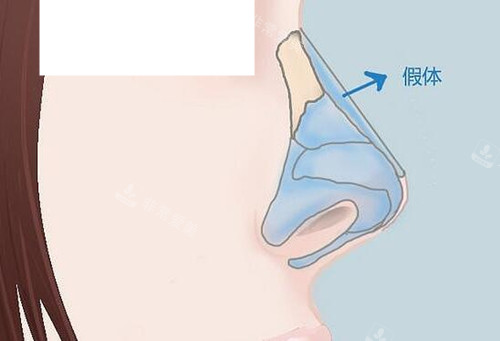 假體隆鼻示意圖