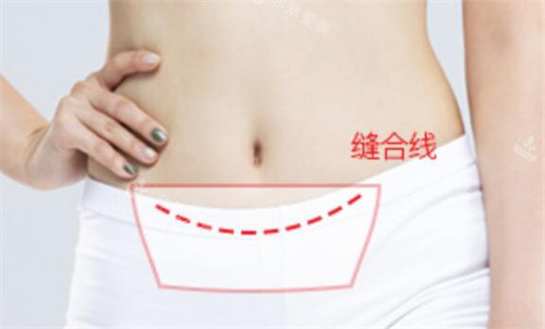 韩国欧佩拉迷你腹部整形术缝合线示意图